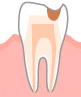C2 象牙質の虫歯